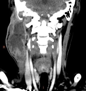 Bezold-abscess-CT.jpg